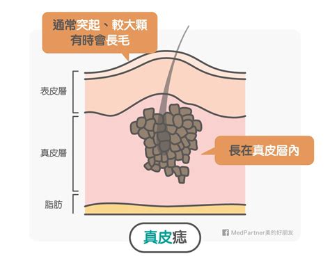 點痣禁忌|點痣筆一擦，黑痣就掉了？醫師冷笑科科兩聲：「點痣」沒你想得。